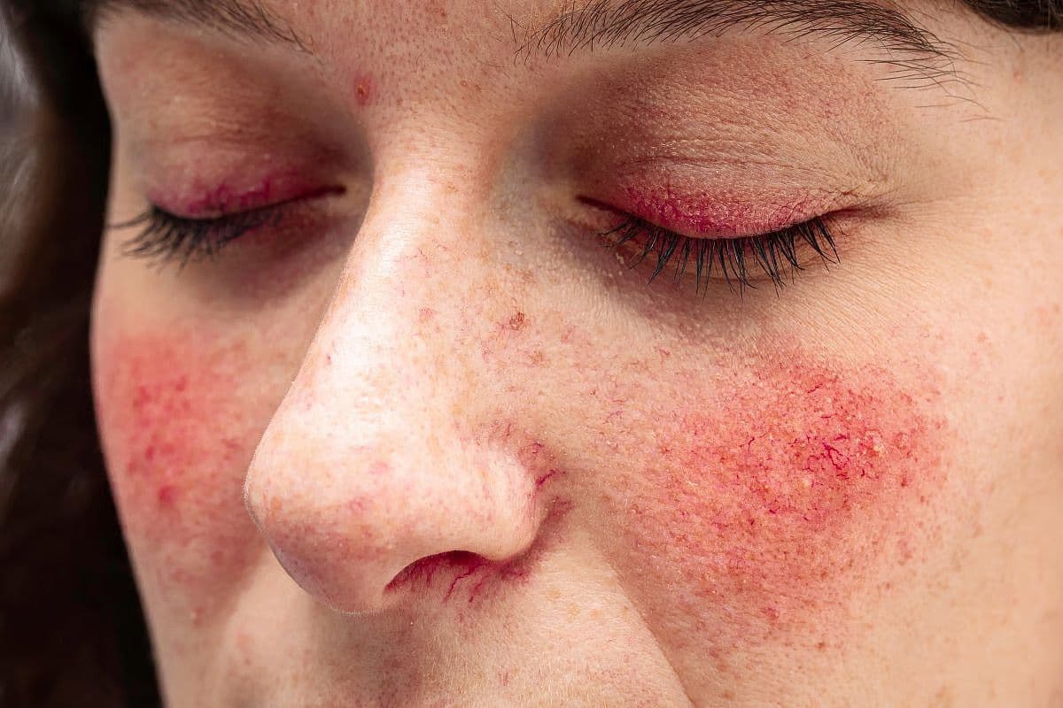 Holistic Approach Recommended for Rosacea in Pregnancy