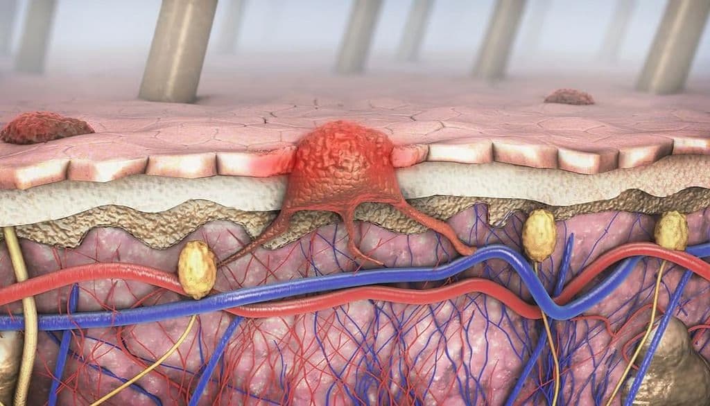 Mitochondrial Genetics Key to Metastatic Melanoma Immunotherapy Resistance