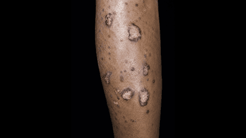 Skin Signals: Cutaneous Lupus Erythematosus Manifestations and Management
