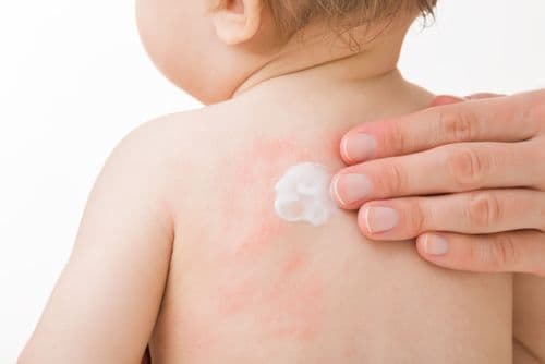 Ripple Effect: Targeted Topical Innovations in Pediatric Atopic Dermatitis 