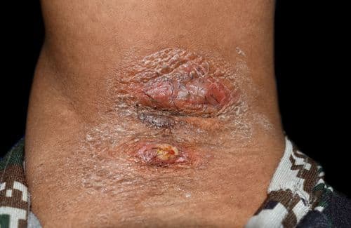 Under the Skin: Targeting the Mechanisms Underlying Hidradenitis Suppurativa