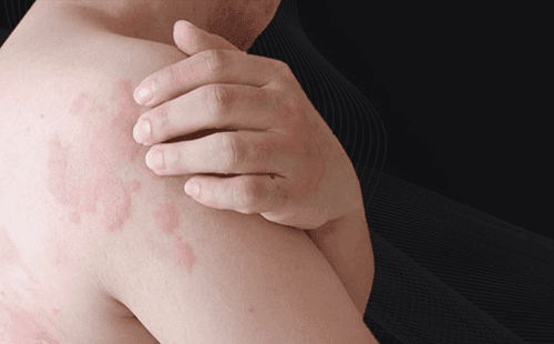 FC24: Evolving Therapies in the Treatment of Chronic Spontaneous Urticaria: An Online Activity