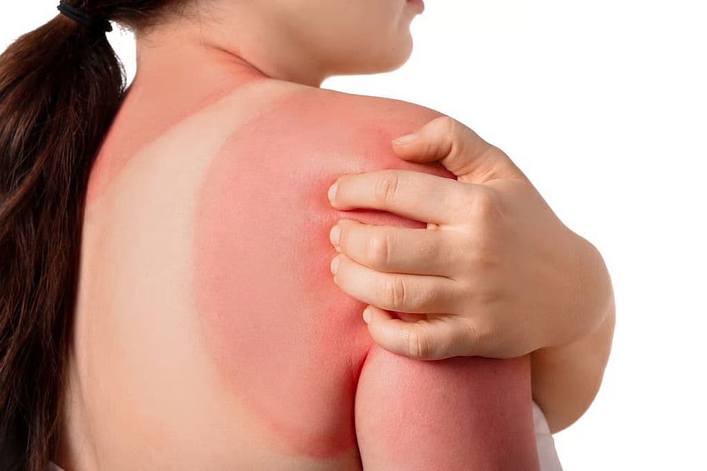 Painful, Blistering, Severe Sunburn Tied to Higher Risk for Squamous Cell Carcinoma