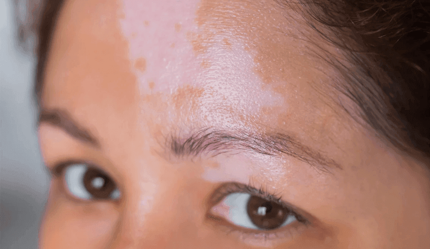 Vitiligo Has Considerable Impact on Mental Health
