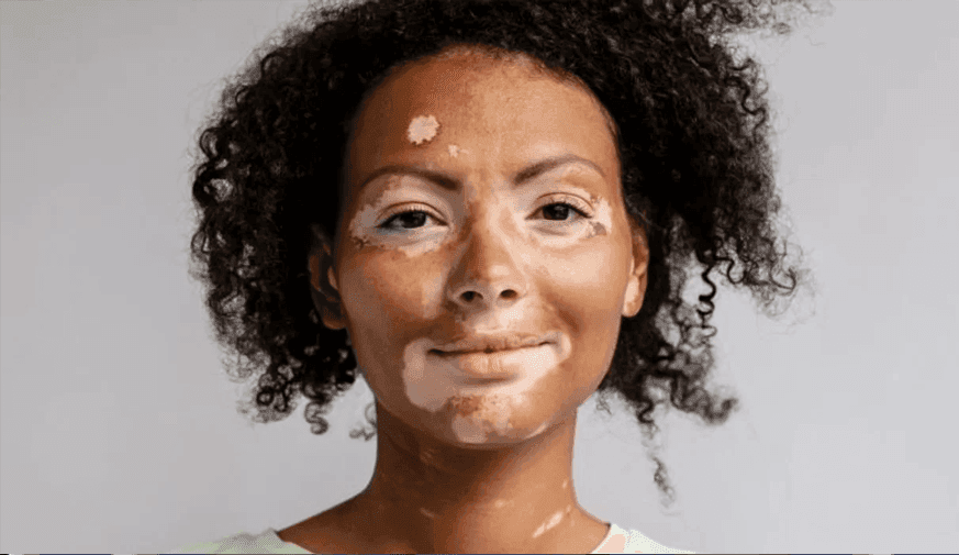 Combo Treatments Efficacious for Generalized-Type Vitiligo