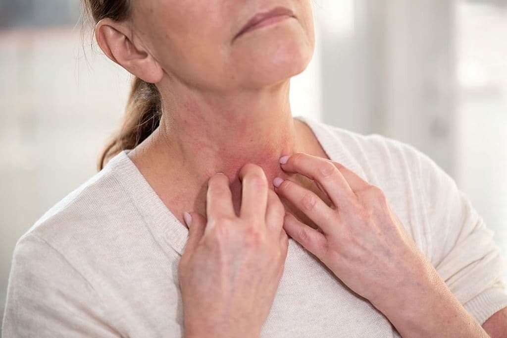 Younger Patients Exhibit Faster Radiation Dermatitis Resolution