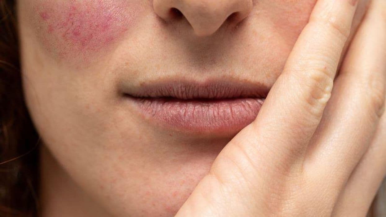 Twelve-Week Treatment Regimen Reduces Facial Redness
