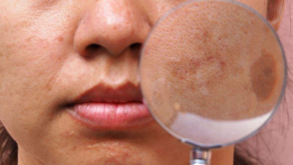 Is Tranexamic Acid, Platelet Rich Plasma Effective for Melasma?