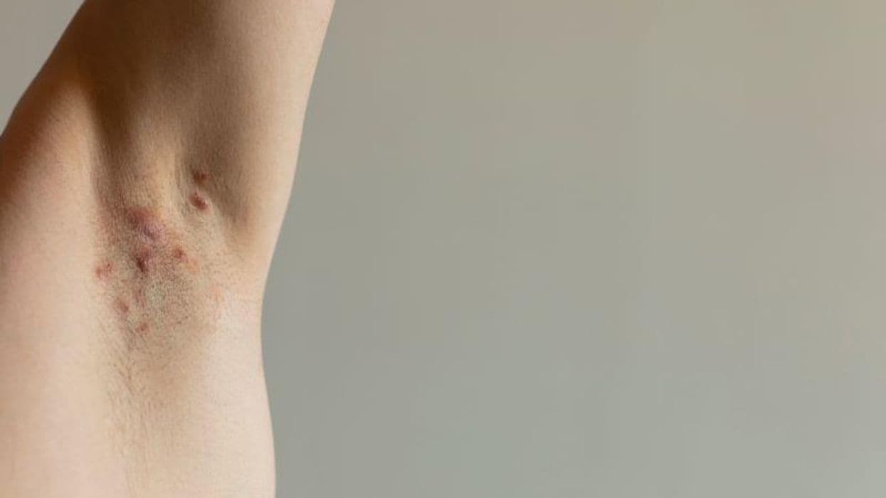 Many Hidradenitis Suppurativa Patients Dissatisfied With Treatment
