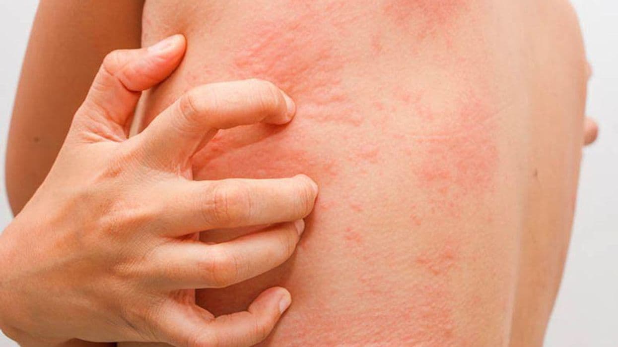 Study Compares Benefits, Harms of Treatments for Chronic Hives