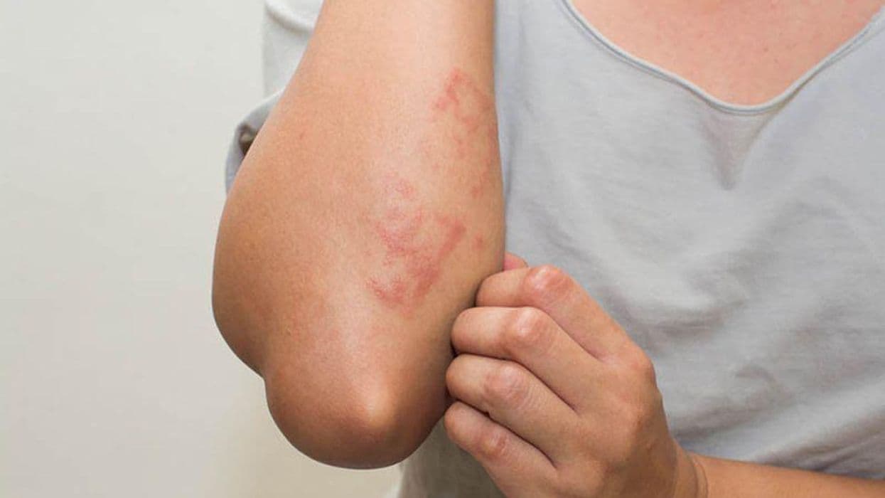 FDA Approves Dupixent for Prurigo Nodularis