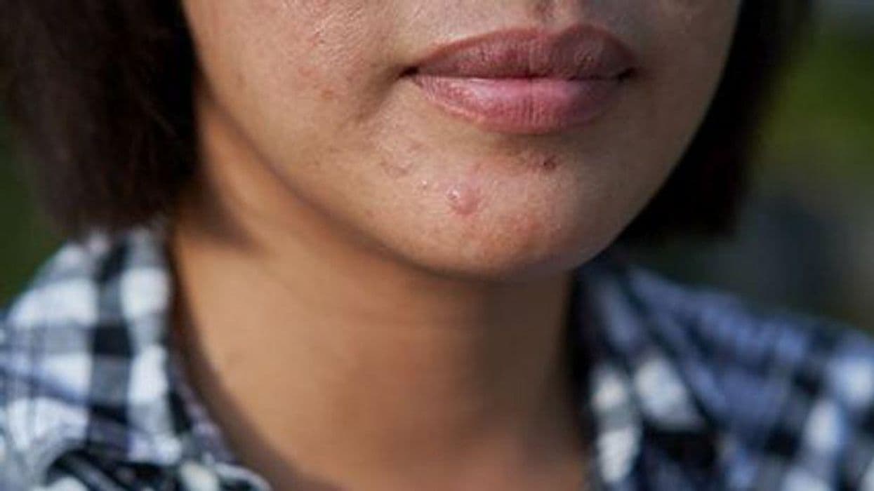 Isotretinoin Does Not Up Suicide Risk in Acne Patients