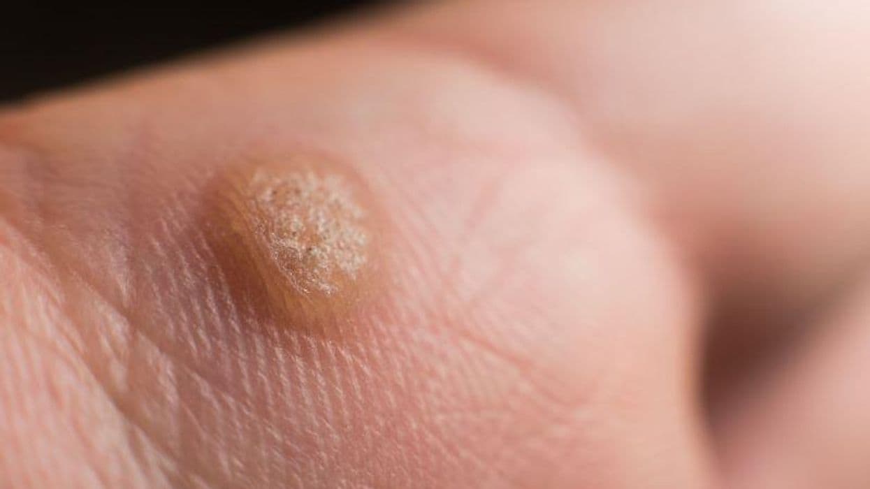 Is Needle-Free Injection of 5-FU Effective for Palmoplantar Warts?