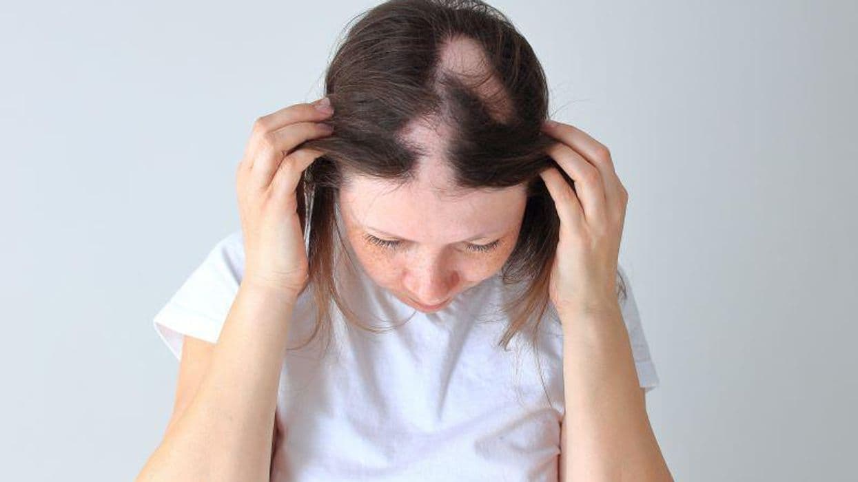 FDA Approves First Pill to Treat Severe Alopecia Areata