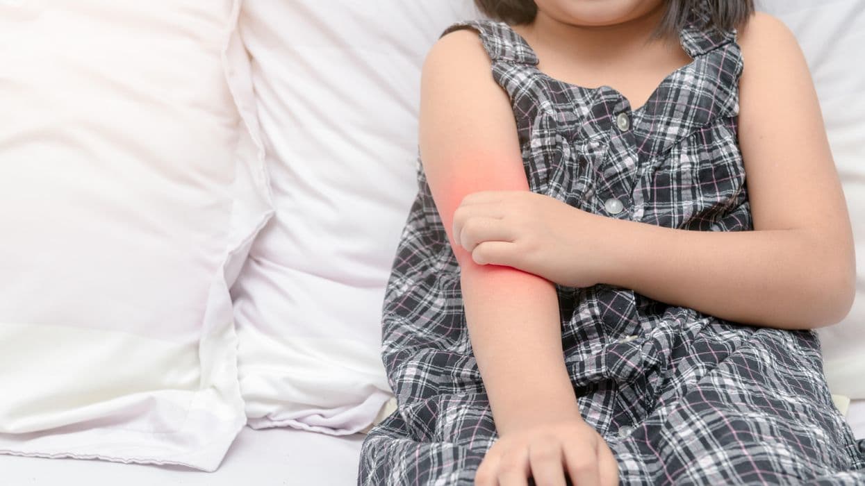 Genetic, Environmental Prenatal Risk Factors Play Role in Early Atopic Dermatitis