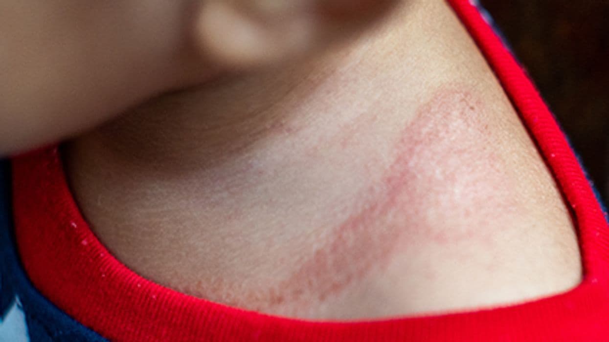 Early-Life Exposure to Antibiotics Linked to Atopic Dermatitis