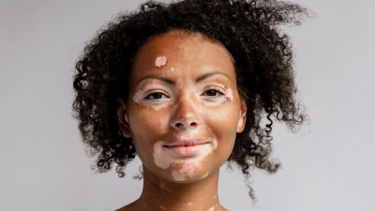 Long-Term Improvement Seen With Ruxolitinib in Vitiligo