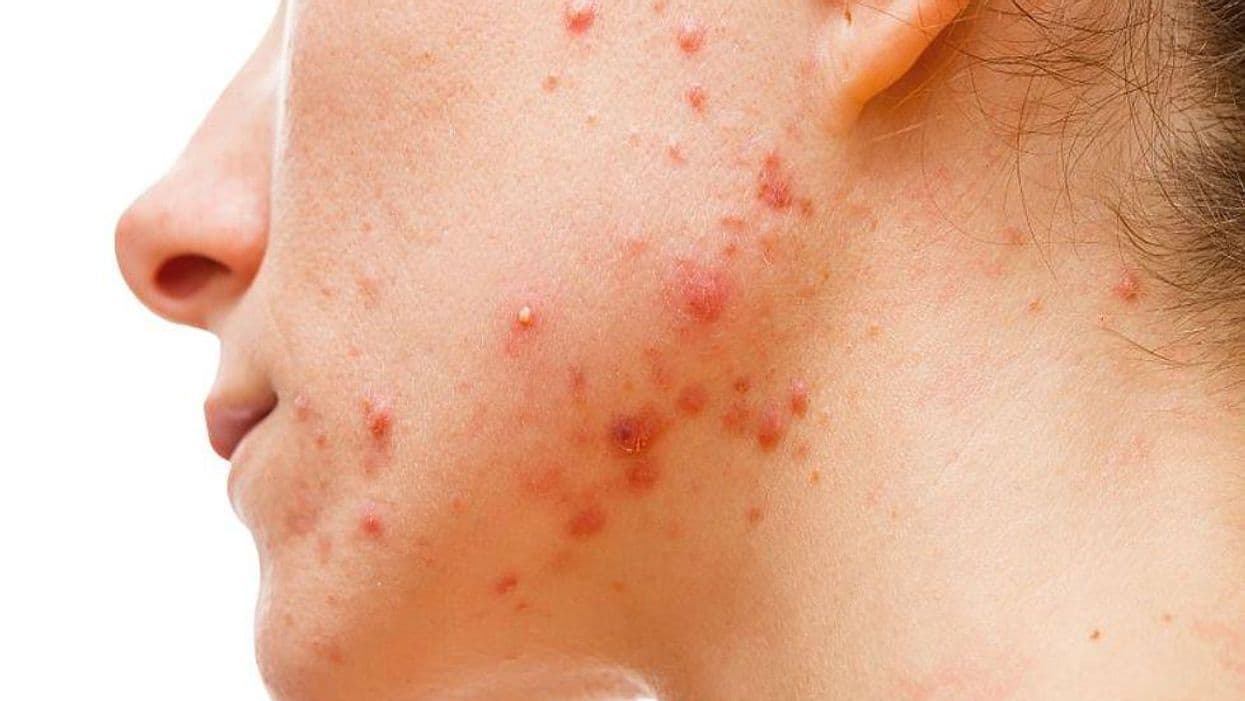 Could Omega-3 Fatty Acids Fight Acne?
