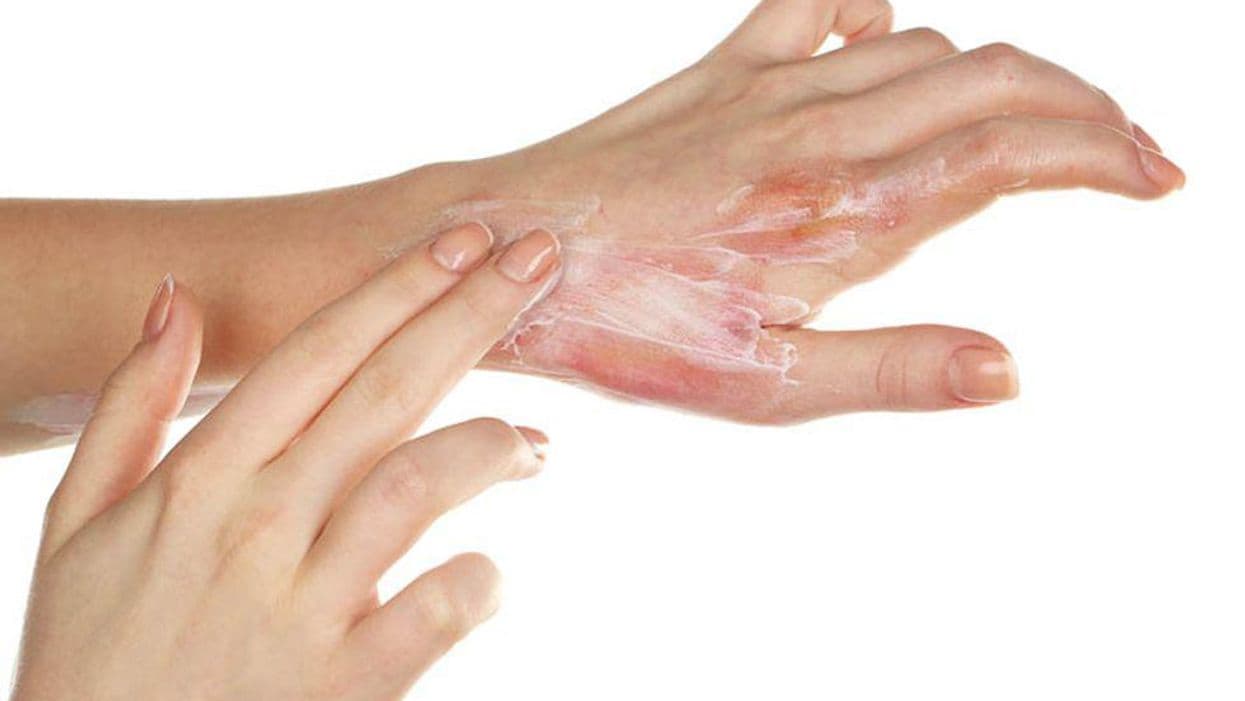 What Is the Efficacy of Ruxolitinib Versus Vehicle in Atopic Dermatitis?