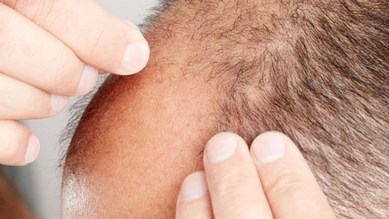 Which Treatment Is Most Efficacious for Male Androgenetic Alopecia?