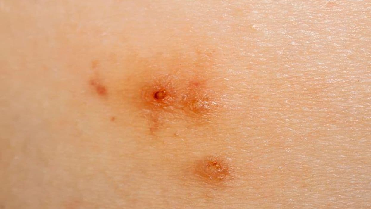 AAD: Berdazimer Gel Clears Molluscum Contagiosum Lesions