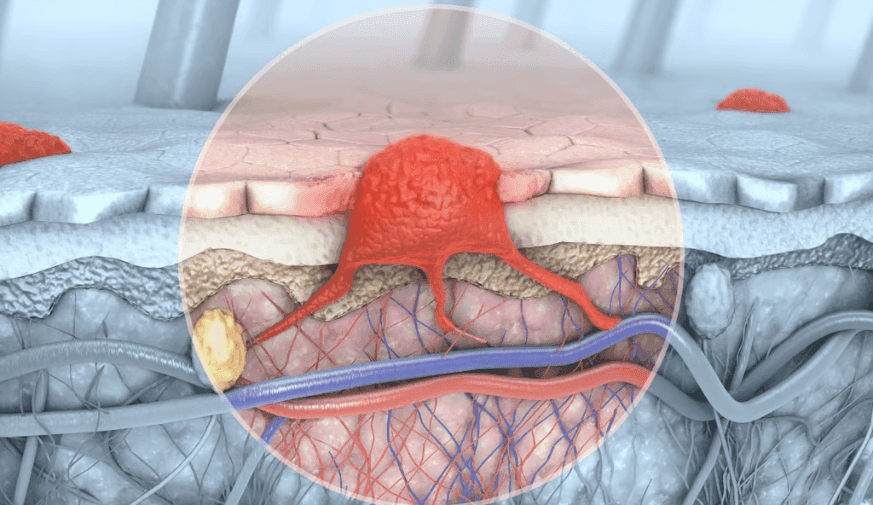 Study IDs Factors Linked to Advanced Melanoma Presentation