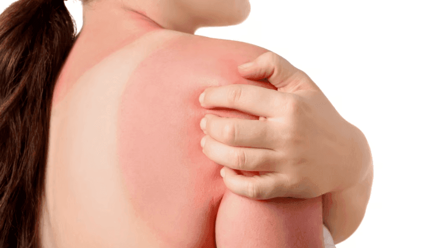 UV Exposure Continues to Be Linked to Increased Melanoma Incidence in Those With Fair Skin