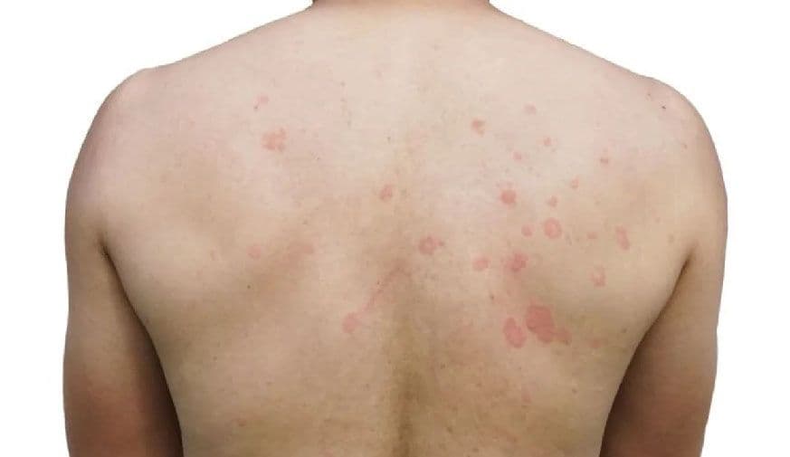 Eosinophilic Cellulitis Seems to Be Type 2 Inflammatory Disease