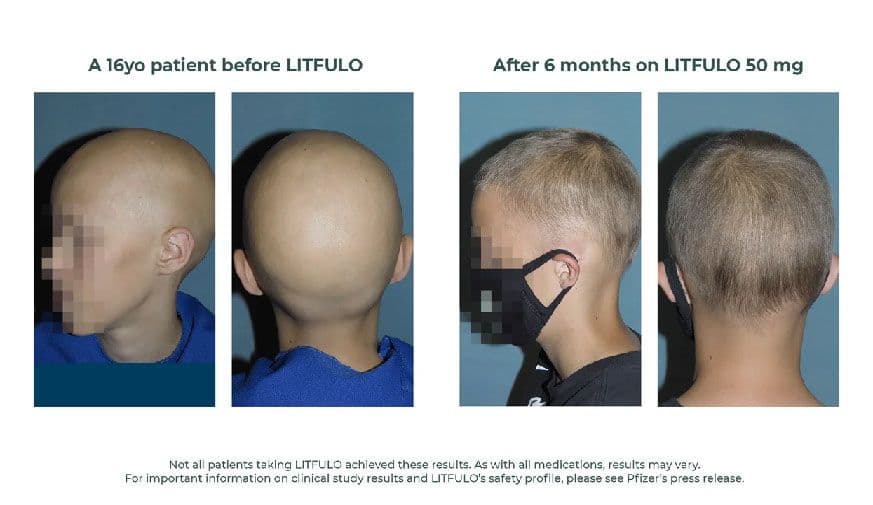 FDA Approves Litfulo for Teens, Adults With Alopecia Areata