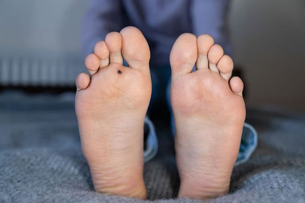 Clinical-Dermoscopic Risk Score Discriminates Plantar Atypical Melanocytic Lesions