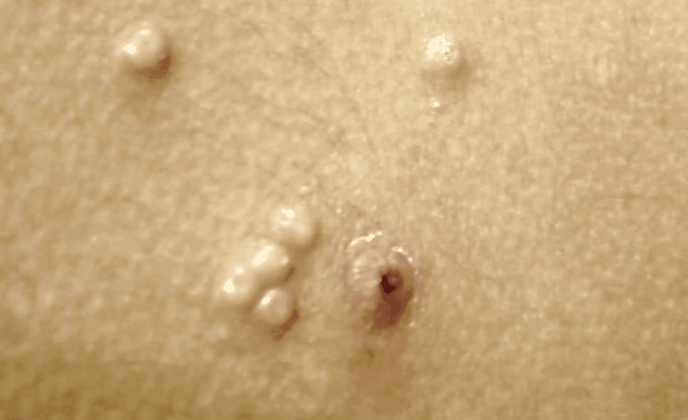 LAUNCH ALERT: FDA Approves YCANTH for Molluscum Contagiosum