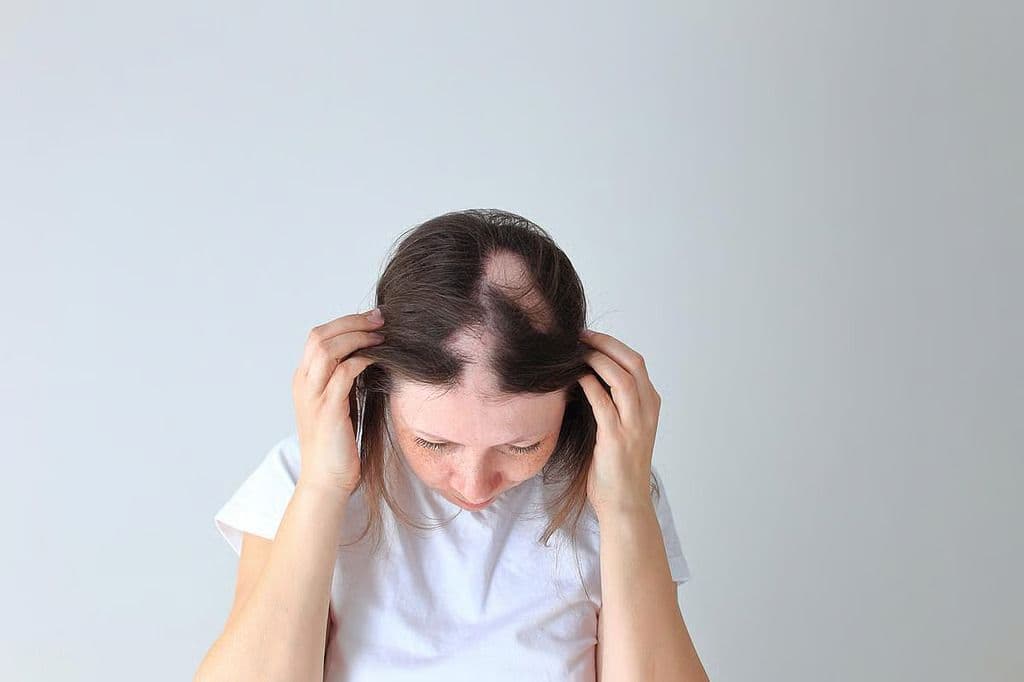 Some Patients With Alopecia Achieve Treatment Success After Switching JAKis