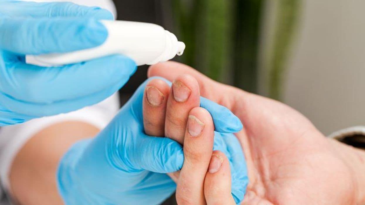 Isolated Nail Psoriasis Does Not Increase Risk for Metabolic Syndrome