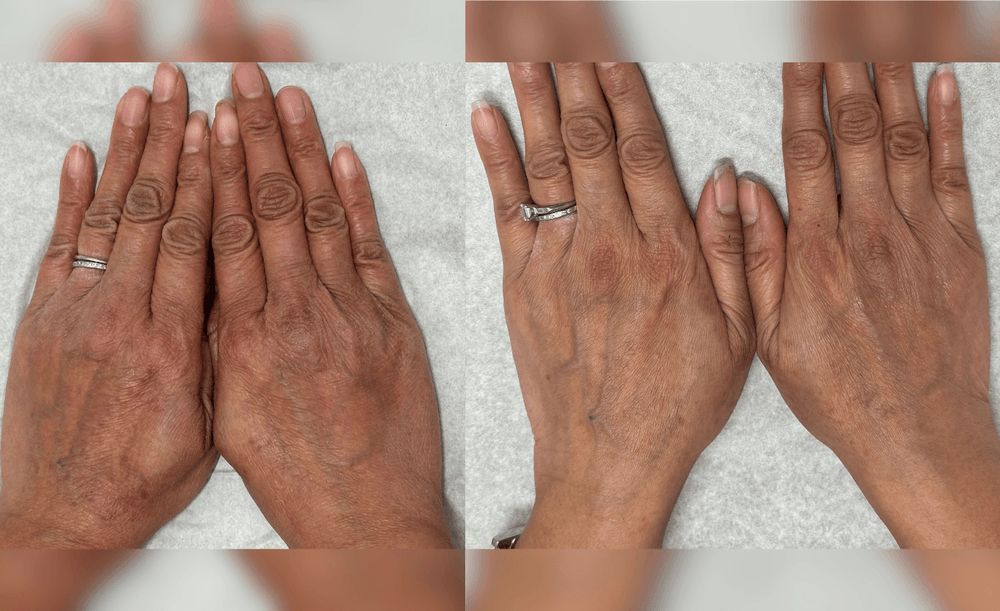 When the Hands Don’t Follow the Rest: Managing Chronic Hand Eczema Despite Systemic AD Control