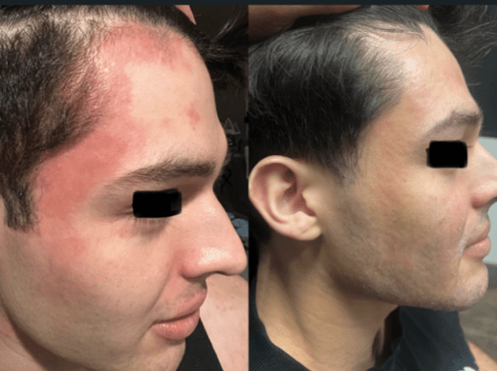Jacked on JAKs: The Therapeutic Impact of Dose Escalation in a Case of Refractory Atopic Dermatitis