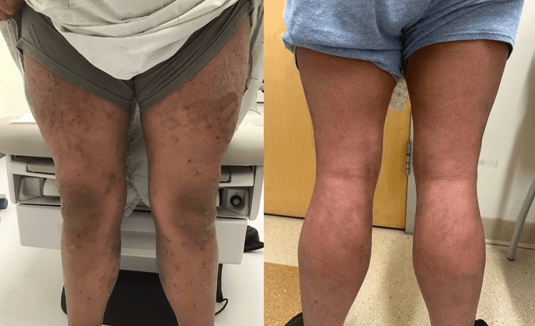 Lifelong Atopic Dermatitis with Idiopathic Sudomotor Failure: Response to Lebrikizumab After Dupilumab Failure