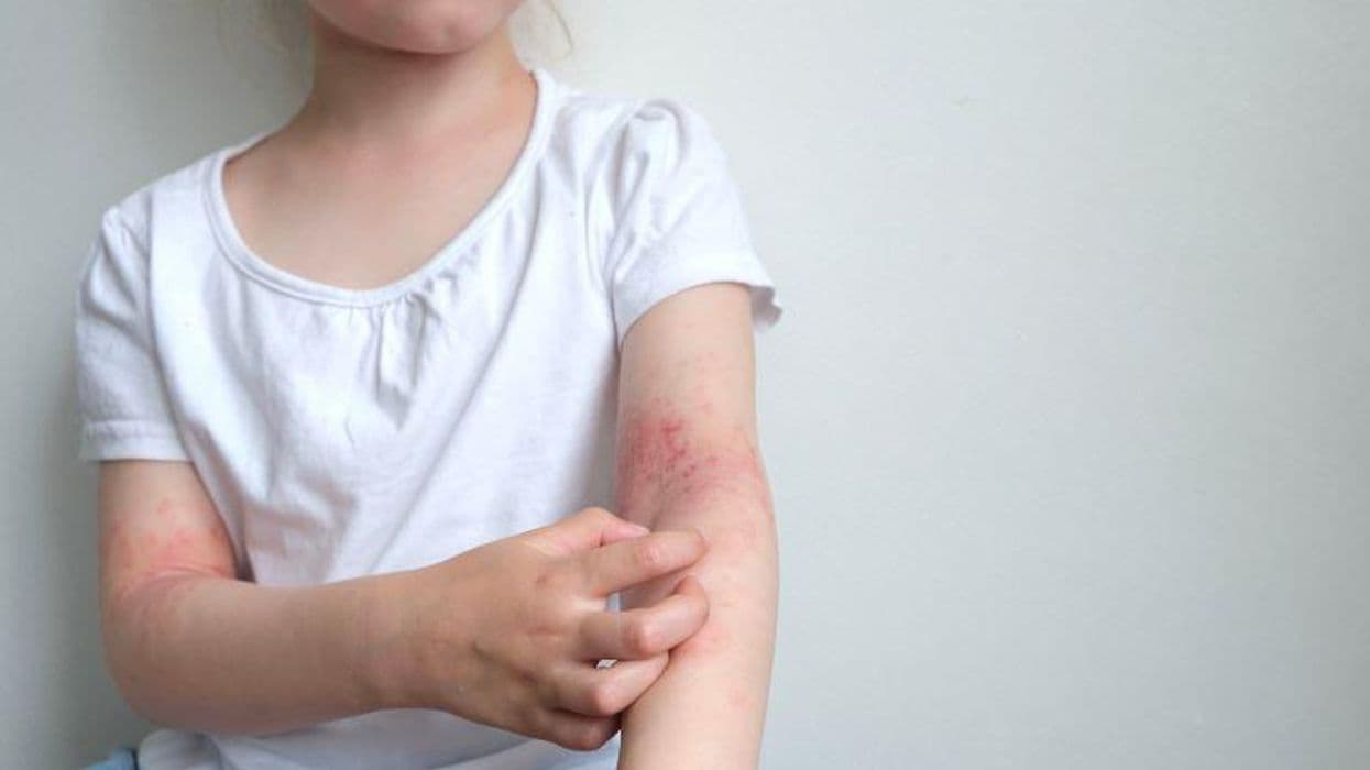 1997 to 2018 Saw Increase in Prevalence of Eczema in Children