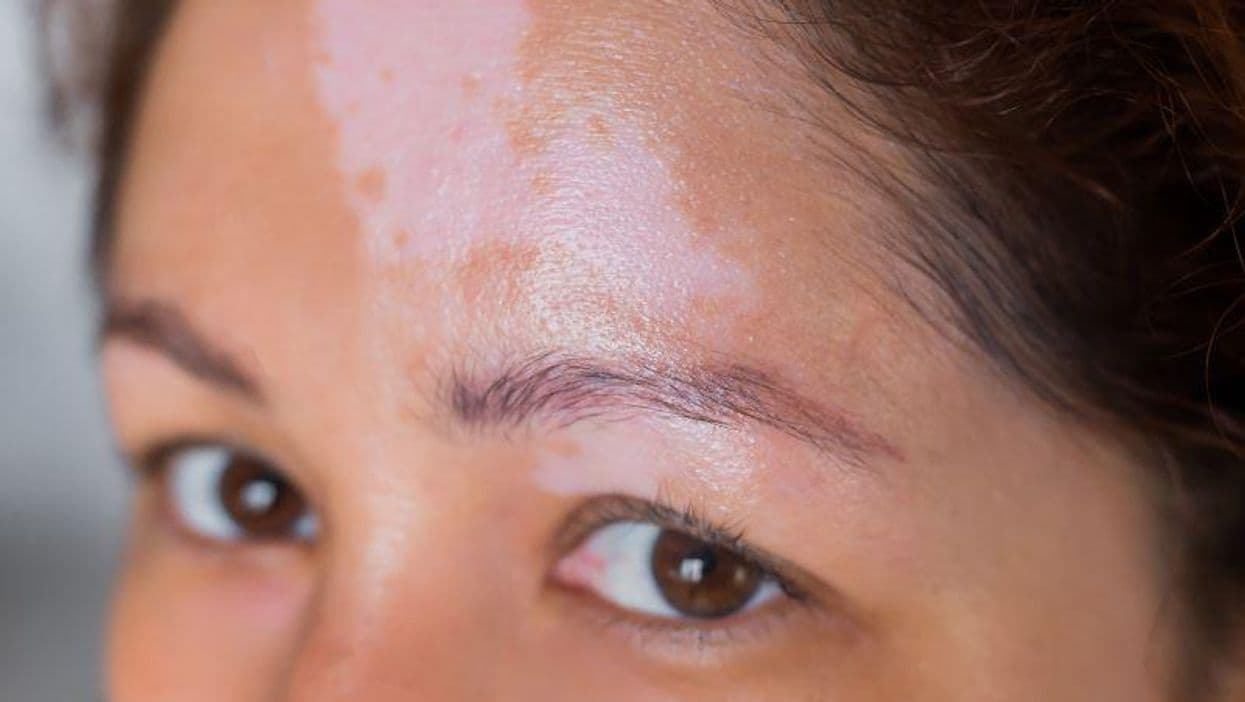 AAD: Ruxolitinib Beneficial in Nonsegmental Vitiligo