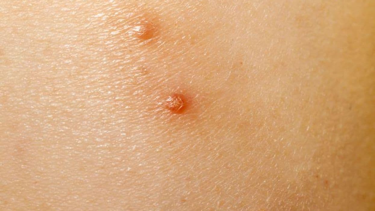 Berdazimer Gel Efficacious, Safe for Molluscum Contagiosum