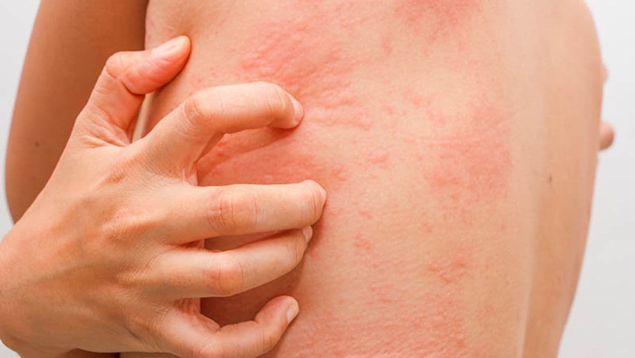 Children With Worse Atopic Dermatitis More Likely to Have Learning Disabilities