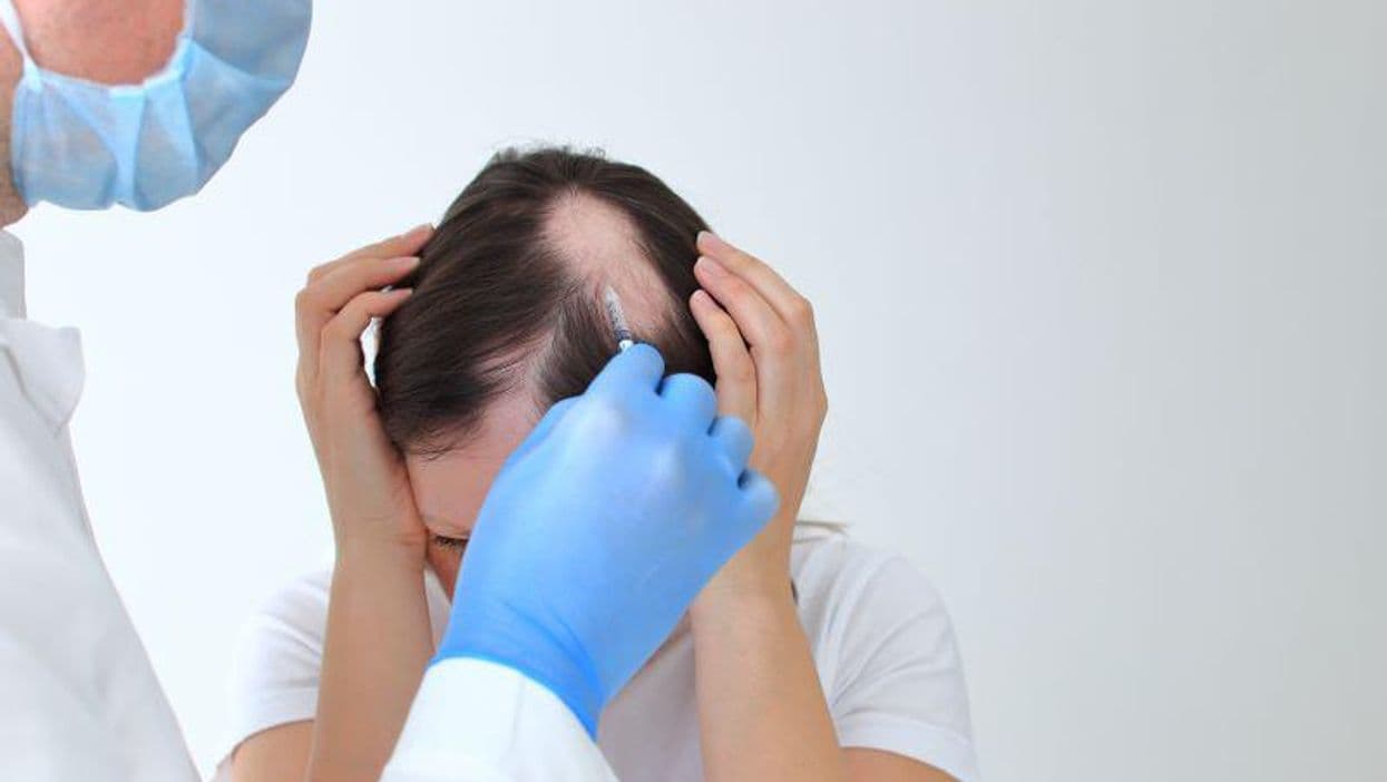 Clinical Experts Develop Severity Scale for Alopecia Areata