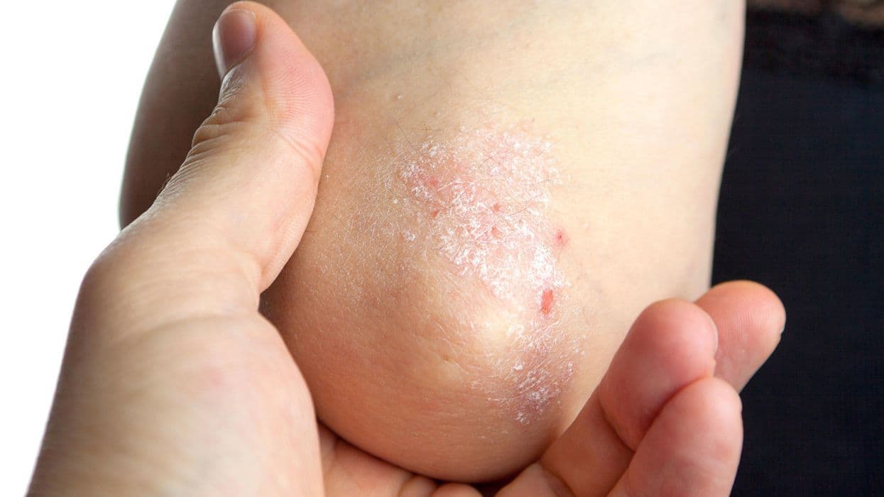 Diagnosis of Psoriasis May Be Delayed in Primary Care