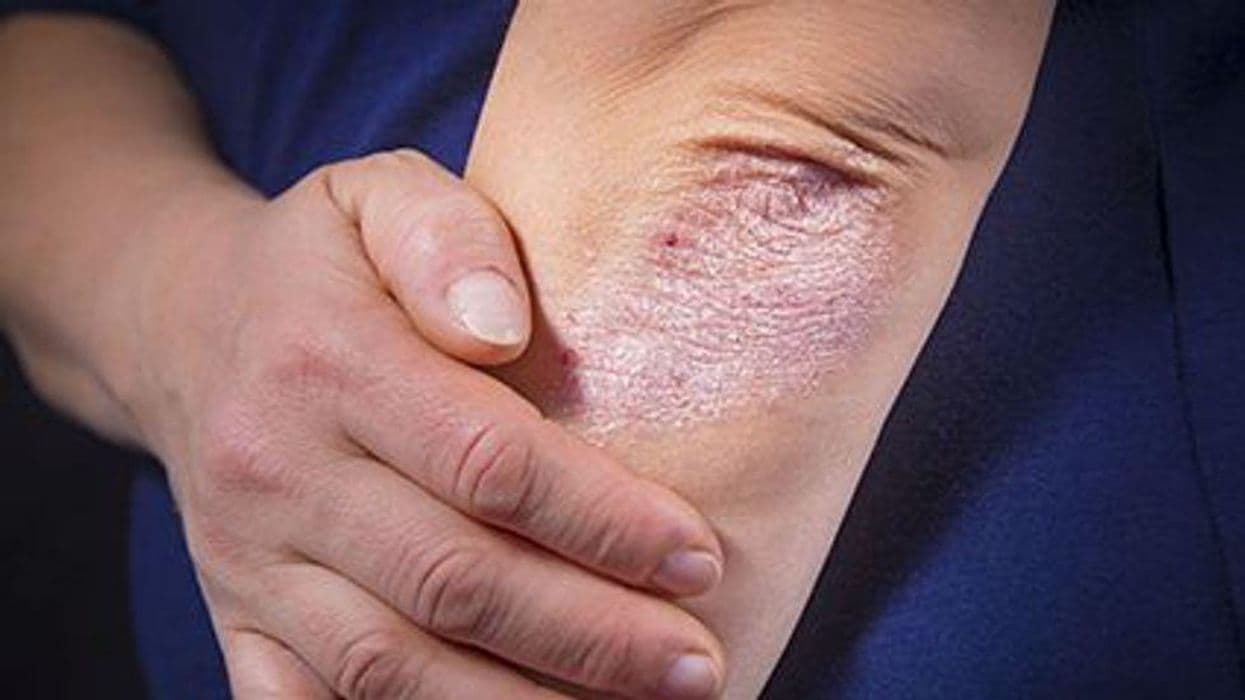 Does Abatacept Cut Psoriasis Relapse After Ustekinumab Withdrawal?