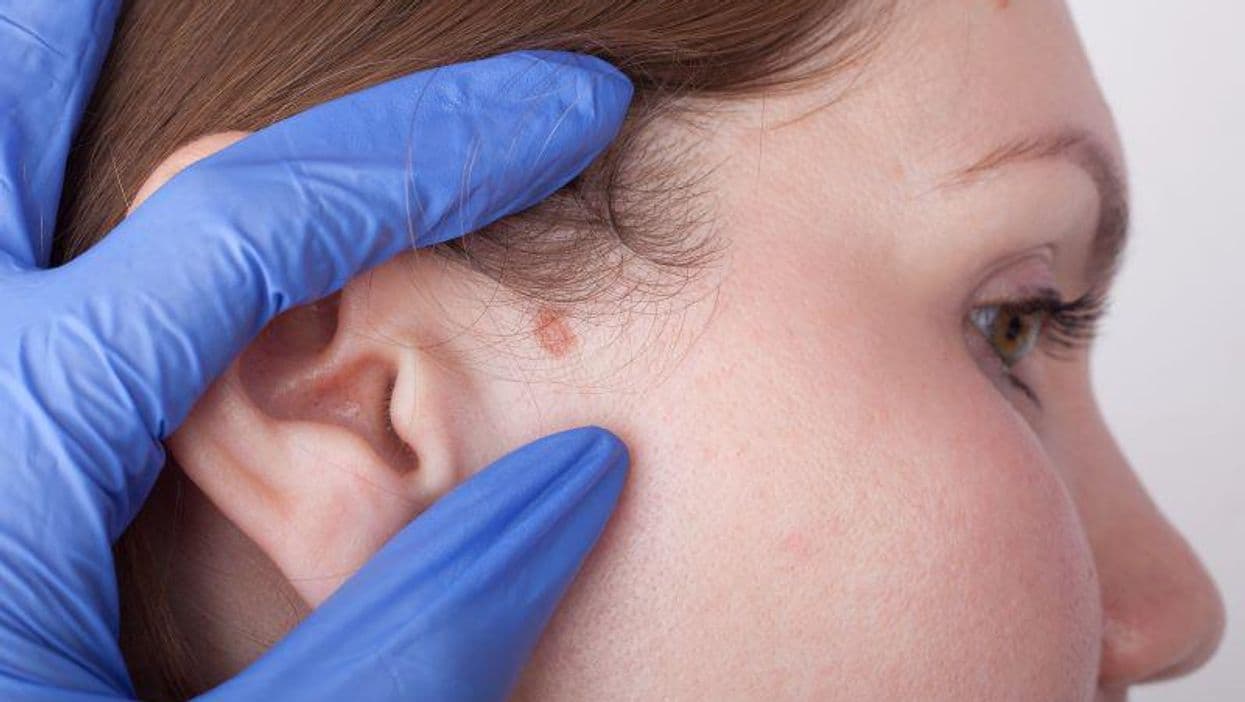 Does Invasive cSCC Risk Increase With Severe Actinic Keratosis Lesions?