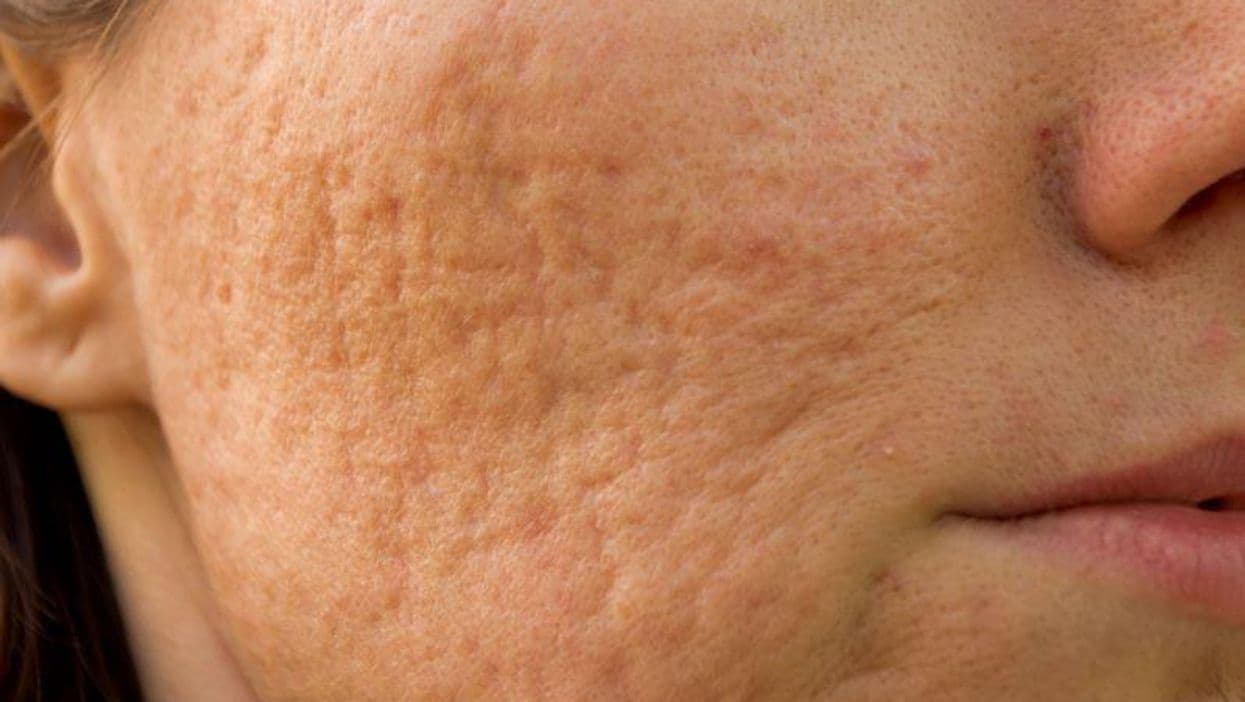 Does Microneedling With Vitamin C Serum or Insulin Aid Postacne Scarring?