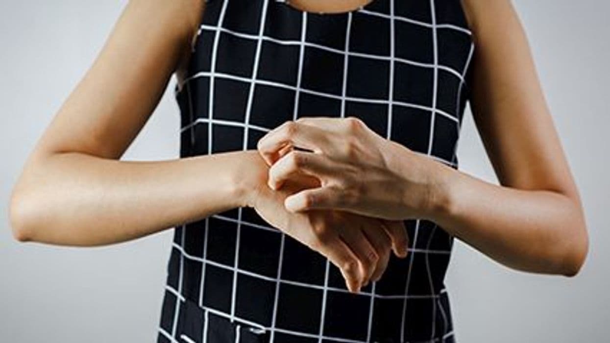 Does Upadacitinib Have Long-Term Efficacy in Moderate-to-Severe Dermatitis?