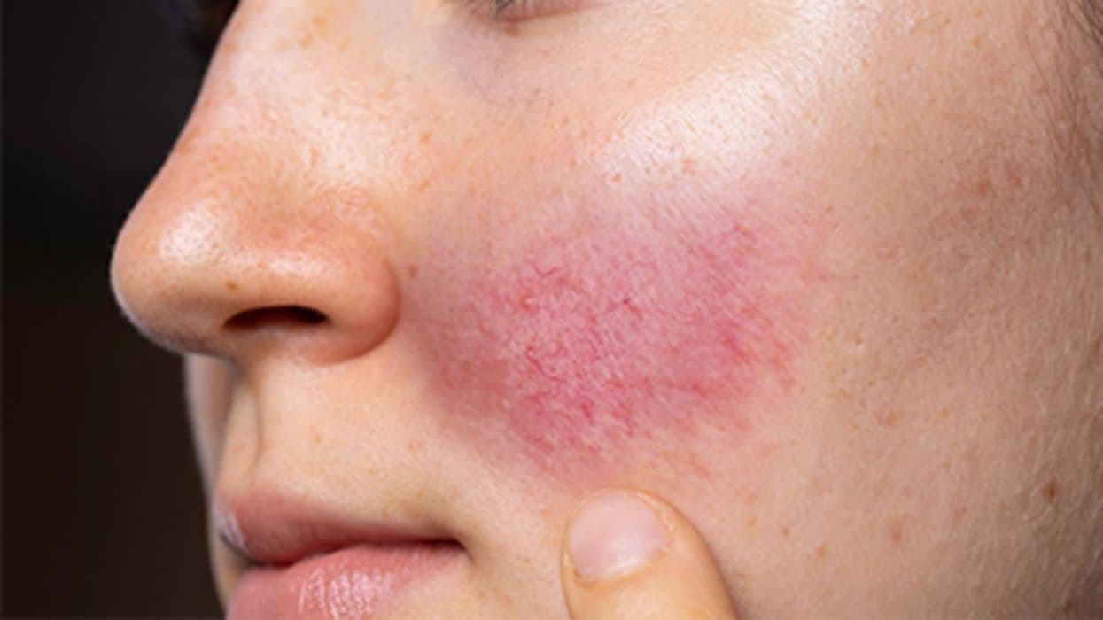 Dupilumab Tied to Facial, Neck Erythema