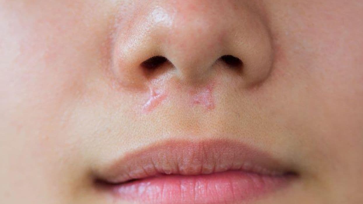 Facial Scars Do Not Affect Perceived Attractiveness, Confidence