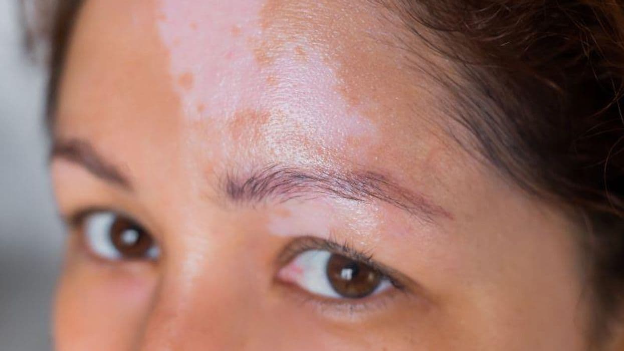 Facial Vitiligo Area Scoring Index Reliable for Facial Involvement