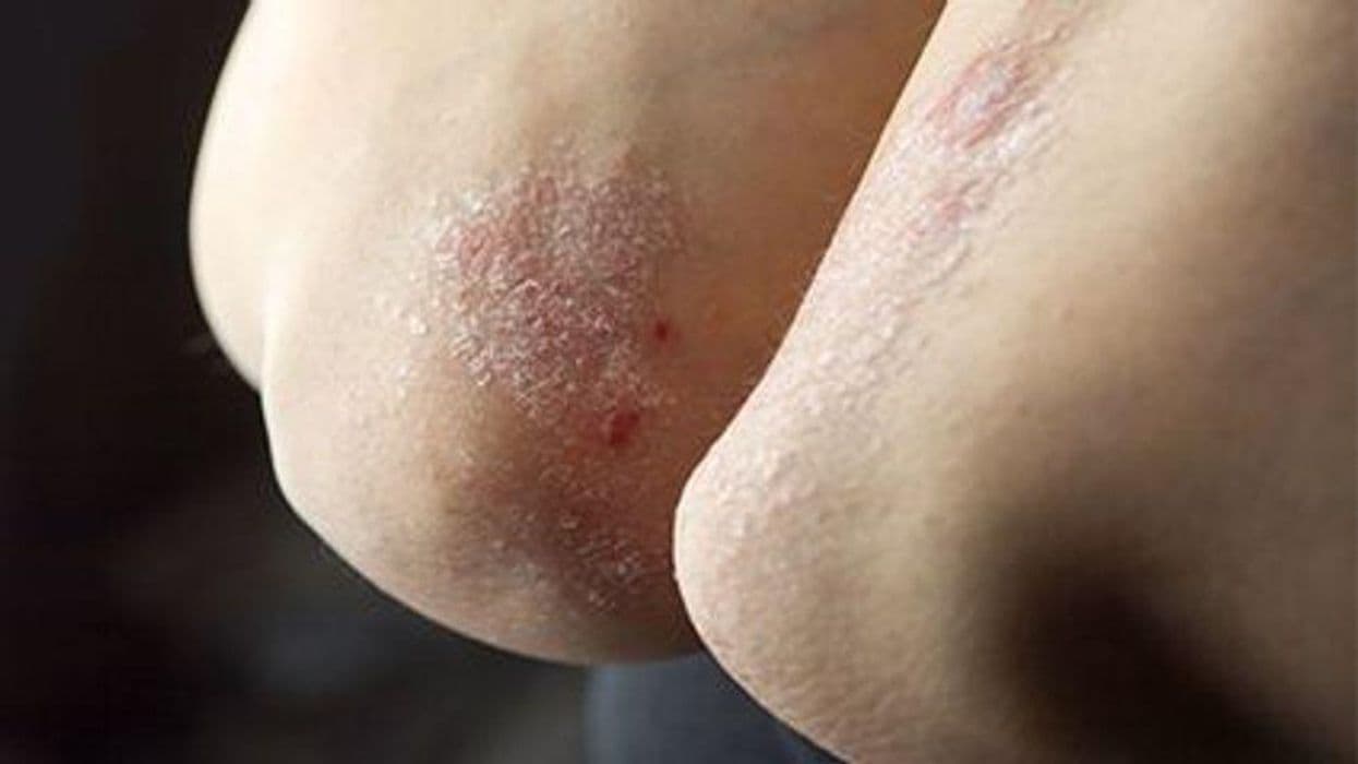 FDA Approves Rinvoq for Treatment of Atopic Dermatitis